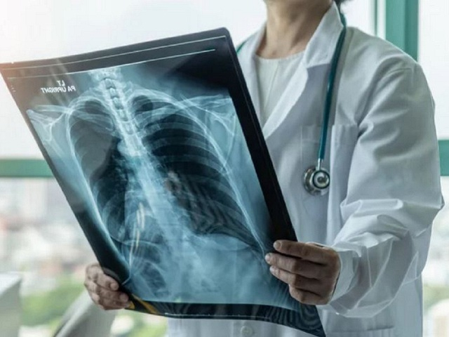 Khi phân tích ảnh chụp X-quang phổi, AI có thể sàng lọc ung thư phổi tốt hơn bác sĩ